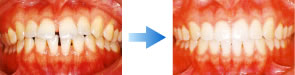 空隙歯列弓（くうげきしれつきゅう） - 治療前/治療後