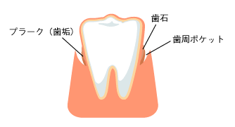 歯周病（歯槽膿漏） - 図解